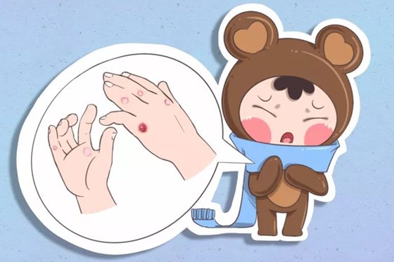 人为什么会生冻疮生冻疮怎么办